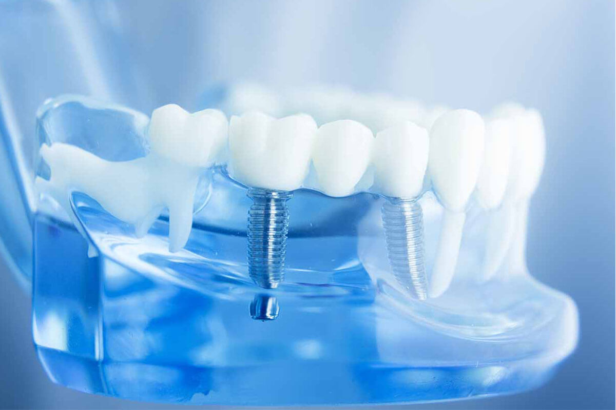 İmplant Diş Tedavisinde Risk Var Mıdır? Dental İmplantın Riskleri