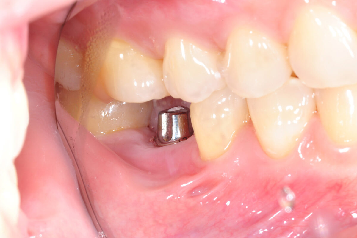 Kısmi diş eksikliğinde implant tedavisi Meltem Diş Poliklinikleri