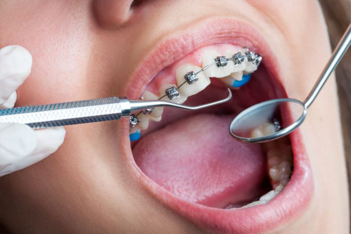Ortodonti Fiyatları 2019 Ortodonti ve Diş Teli Tedavisi Ücretleri
